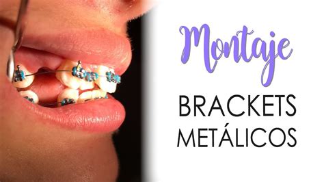 MONTAJE DE BRACKETS METÁLICOS 